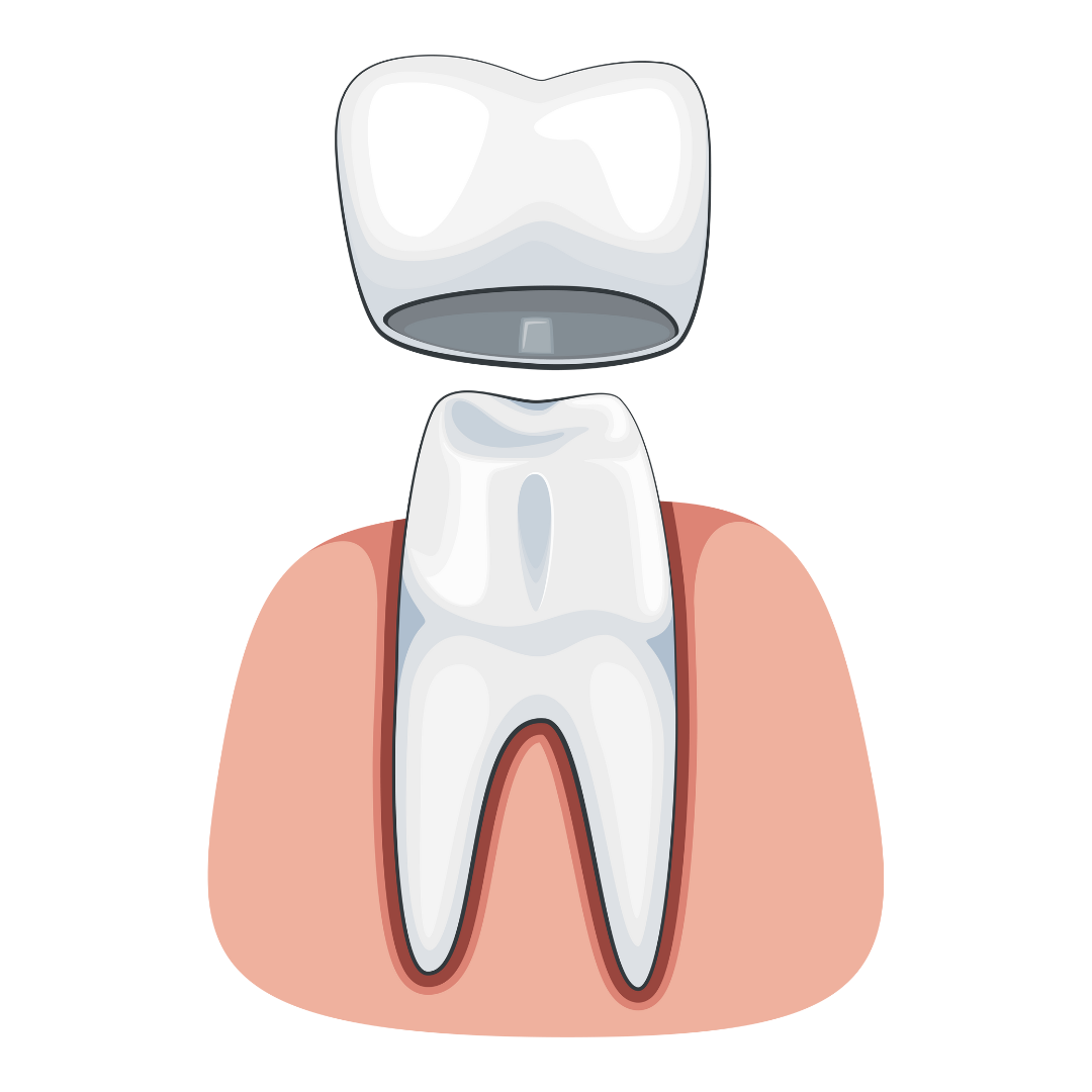 Does every Root Canal Treated Tooth Need a Dental Crown Cap